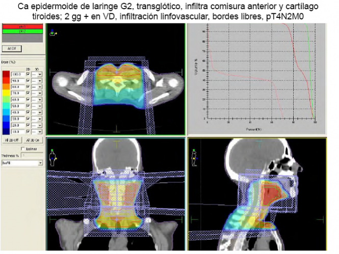 La localización del cáncer de cabeza y cuello permite una manifestación temprana de síntomas, pero las recaídas son muy frecuentes (fuente: ponencia Dra. Laura Cerezo en el I Curso de Formación Conjunta en Tumores de Cabeza y Cuello).